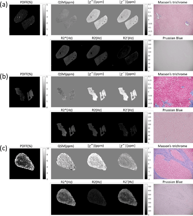 Figure 3 for MRI quantification of liver fibrosis using diamagnetic susceptibility: An ex-vivo feasibility study