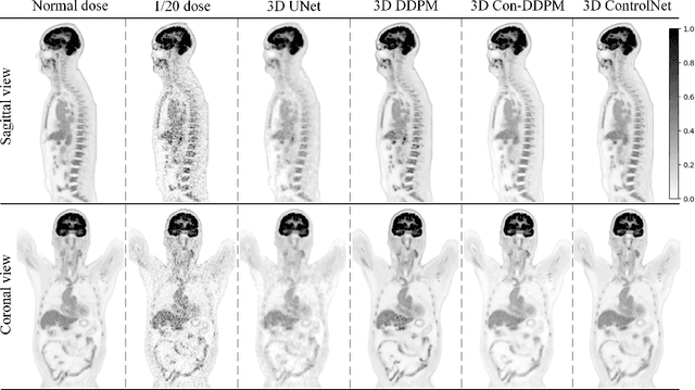 Figure 2 for Adaptive Whole-Body PET Image Denoising Using 3D Diffusion Models with ControlNet