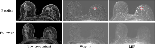 Figure 1 for To deform or not: treatment-aware longitudinal registration for breast DCE-MRI during neoadjuvant chemotherapy via unsupervised keypoints detection