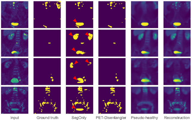 Figure 3 for Disentangled PET Lesion Segmentation