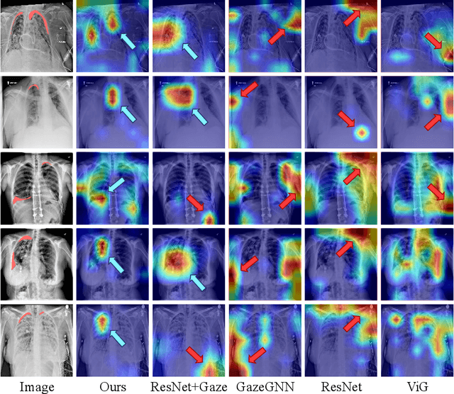 Figure 4 for Gaze-directed Vision GNN for Mitigating Shortcut Learning in Medical Image