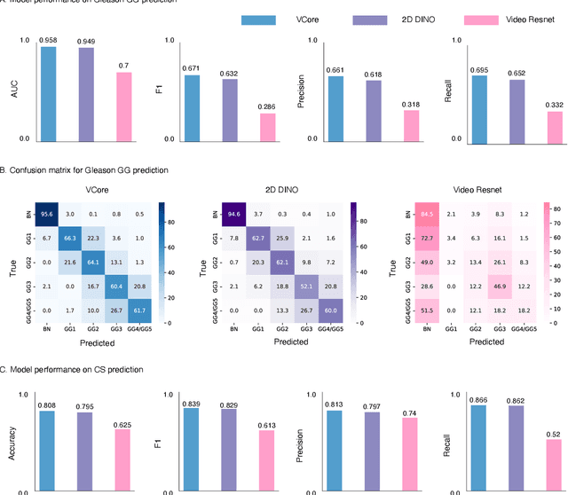 Figure 2 for Digital Volumetric Biopsy Cores Improve Gleason Grading of Prostate Cancer Using Deep Learning