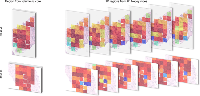 Figure 4 for Digital Volumetric Biopsy Cores Improve Gleason Grading of Prostate Cancer Using Deep Learning