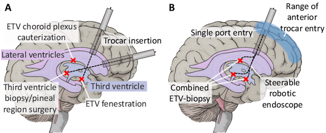 Figure 3 for From Rigid to Soft Robotic Approaches for Minimally Invasive Neurosurgery