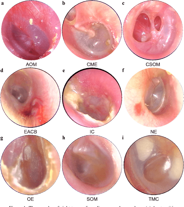 Figure 2 for Ultrafast and Ultralight Network-Based Intelligent System for Real-time Diagnosis of Ear diseases in Any Devices