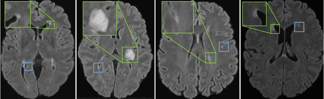 Figure 4 for Self-pruning Graph Neural Network for Predicting Inflammatory Disease Activity in Multiple Sclerosis from Brain MR Images