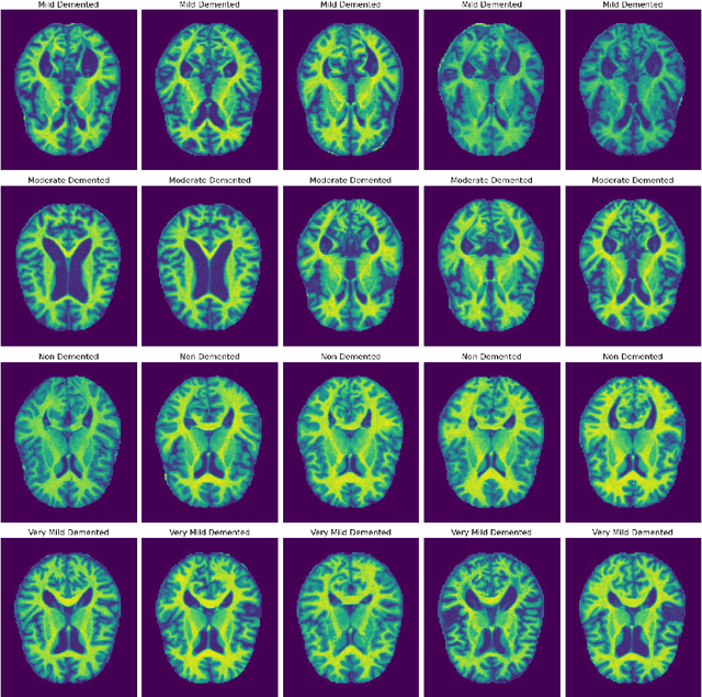 Figure 1 for A Dual-Attention Aware Deep Convolutional Neural Network for Early Alzheimer's Detection