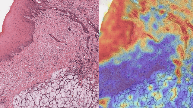 Figure 2 for Whole Slide Image Classification of Salivary Gland Tumours