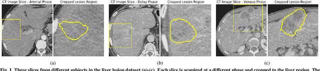 Figure 1 for Multi-target and multi-stage liver lesion segmentation and detection in multi-phase computed tomography scans