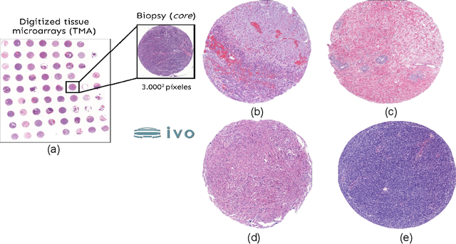 Figure 1 for Exploring visual language models as a powerful tool in the diagnosis of Ewing Sarcoma