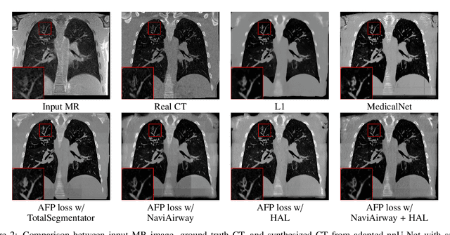 Figure 3 for Anatomical feature-prioritized loss for enhanced MR to CT translation