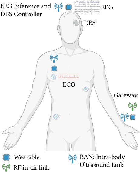 Figure 1 for A Multi-Modal Non-Invasive Deep Learning Framework for Progressive Prediction of Seizures