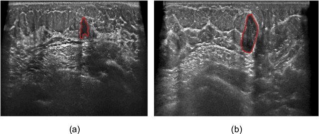 Figure 1 for Tumor Detection, Segmentation and Classification Challenge on Automated 3D Breast Ultrasound: The TDSC-ABUS Challenge