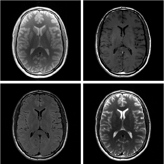 Figure 1 for Conditional Score-Based Reconstructions for Multi-contrast MRI