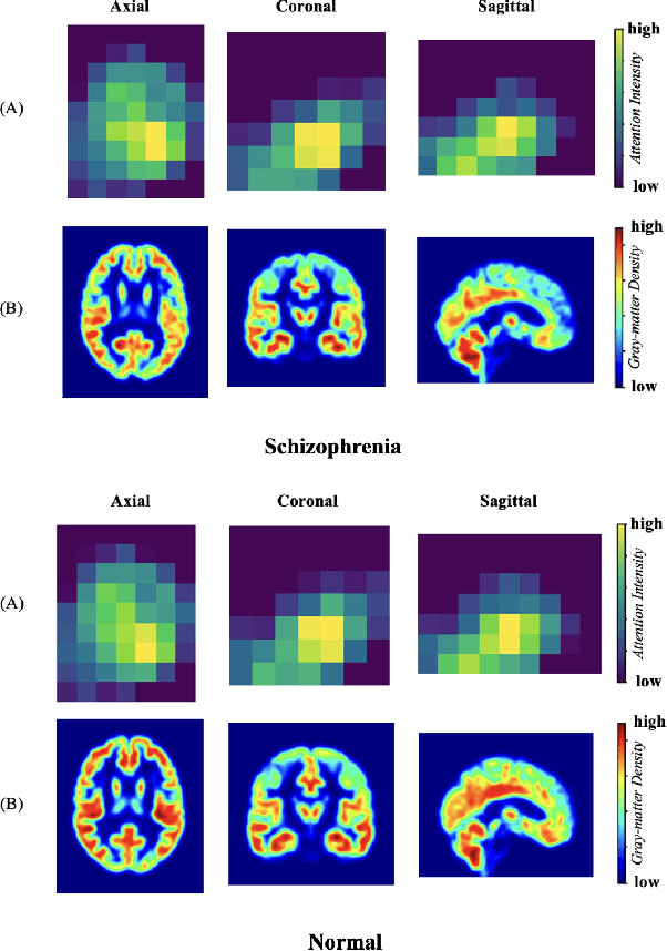 Figure 3 for Spatial Sequence Attention Network for Schizophrenia Classification from Structural Brain MR Images