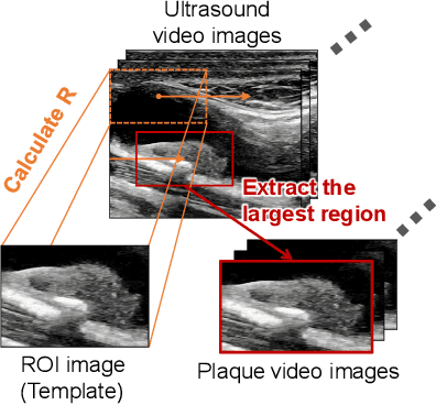 Figure 2 for Classification of Carotid Plaque with Jellyfish Sign Through Convolutional and Recurrent Neural Networks Utilizing Plaque Surface Edges