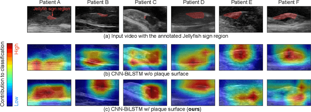 Figure 3 for Classification of Carotid Plaque with Jellyfish Sign Through Convolutional and Recurrent Neural Networks Utilizing Plaque Surface Edges