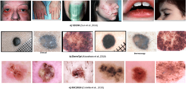 Figure 3 for Meta-Transfer Derm-Diagnosis: Exploring Few-Shot Learning and Transfer Learning for Skin Disease Classification in Long-Tail Distribution