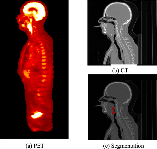 Figure 1 for Prediction of recurrence free survival of head and neck cancer using PET/CT radiomics and clinical information