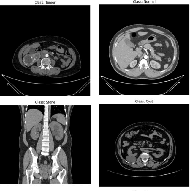 Figure 1 for A Novel Ensemble-Based Deep Learning Model with Explainable AI for Accurate Kidney Disease Diagnosis
