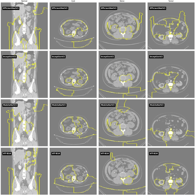 Figure 3 for A Novel Ensemble-Based Deep Learning Model with Explainable AI for Accurate Kidney Disease Diagnosis