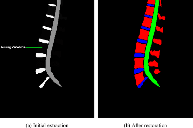 Figure 1 for Pioneering Precision in Lumbar Spine MRI Segmentation with Advanced Deep Learning and Data Enhancement