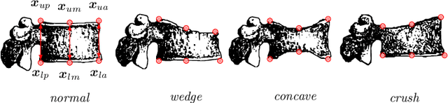 Figure 1 for Explainable vertebral fracture analysis with uncertainty estimation using differentiable rule-based classification