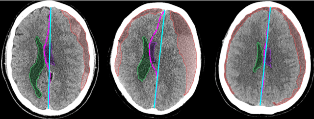 Figure 1 for Brain-Shift: Unsupervised Pseudo-Healthy Brain Synthesis for Novel Biomarker Extraction in Chronic Subdural Hematoma