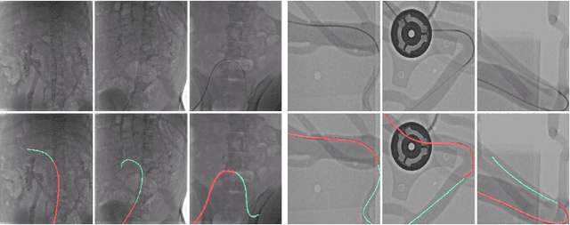 Figure 1 for Shape-Sensitive Loss for Catheter and Guidewire Segmentation