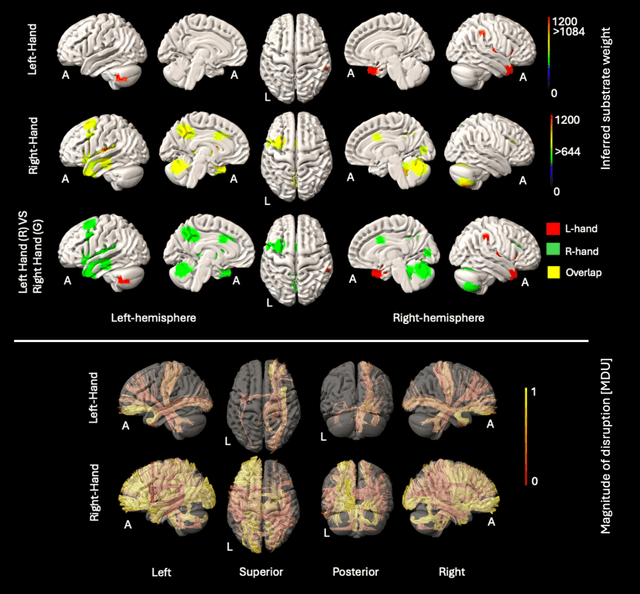 Figure 3 for Deep generative computed perfusion-deficit mapping of ischaemic stroke