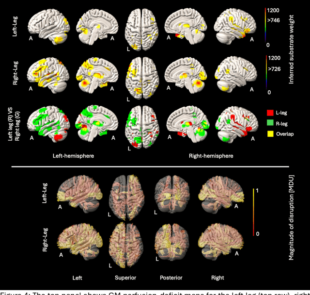 Figure 4 for Deep generative computed perfusion-deficit mapping of ischaemic stroke