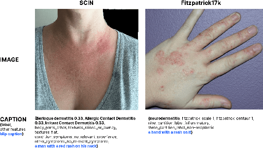 Figure 3 for SkinGEN: an Explainable Dermatology Diagnosis-to-Generation Framework with Interactive Vision-Language Models