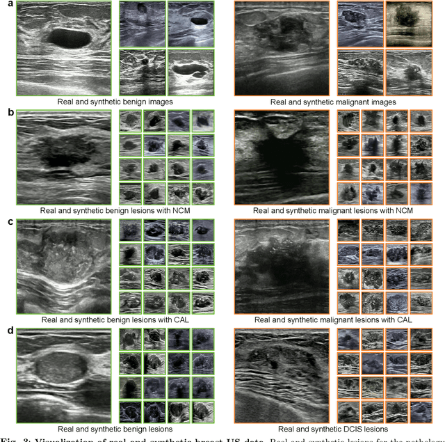 Figure 3 for Knowledge-driven AI-generated data for accurate and interpretable breast ultrasound diagnoses