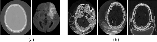 Figure 1 for Class Activation Map-based Weakly supervised Hemorrhage Segmentation using Resnet-LSTM in Non-Contrast Computed Tomography images