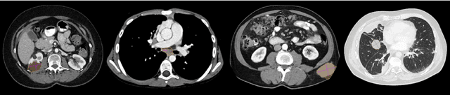 Figure 3 for The ULS23 Challenge: a Baseline Model and Benchmark Dataset for 3D Universal Lesion Segmentation in Computed Tomography