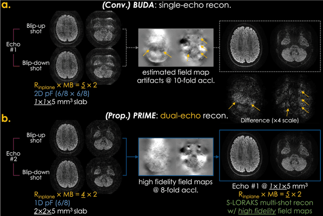 Figure 4 for PRIME: Phase Reversed Interleaved Multi-Echo acquisition enables highly accelerated distortion-free diffusion MRI