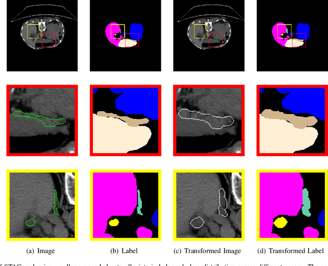 Figure 1 for Shape Transformation Driven by Active Contour for Class-Imbalanced Semi-Supervised Medical Image Segmentation