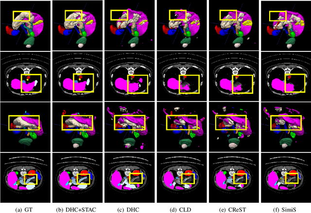 Figure 3 for Shape Transformation Driven by Active Contour for Class-Imbalanced Semi-Supervised Medical Image Segmentation