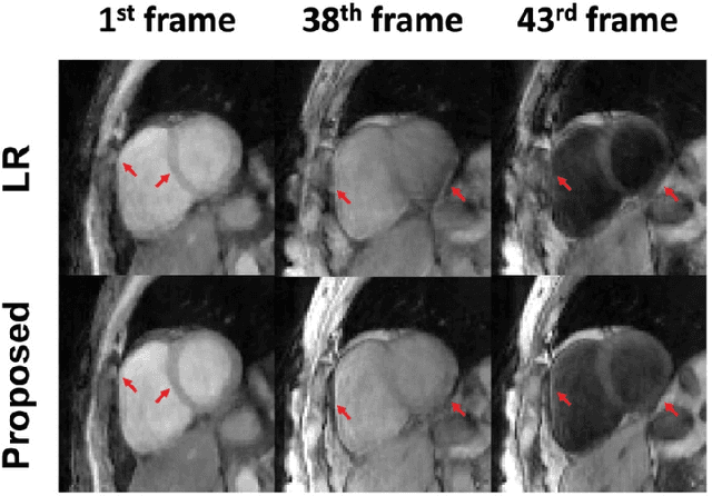 Figure 2 for Free-breathing 3D cardiac extracellular volume (ECV) mapping using a linear tangent space alignment (LTSA) model