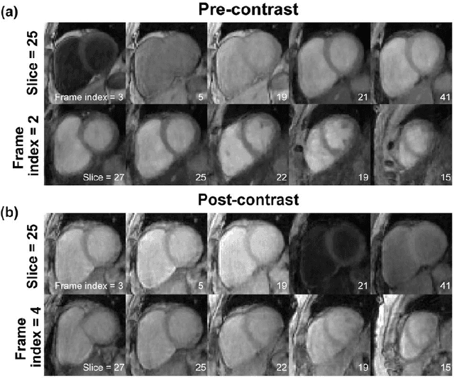 Figure 3 for Free-breathing 3D cardiac extracellular volume (ECV) mapping using a linear tangent space alignment (LTSA) model