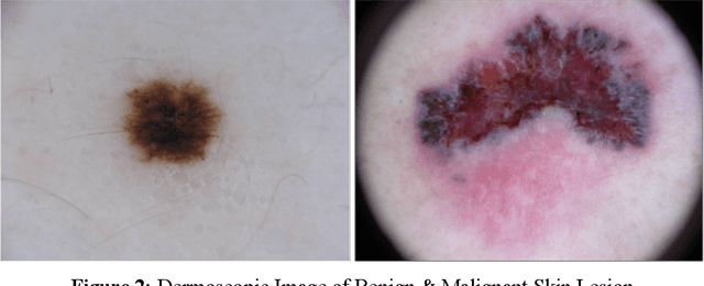 Figure 2 for A Comparative Analysis Towards Melanoma Classification Using Transfer Learning by Analyzing Dermoscopic Images