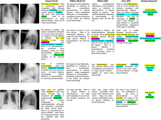 Figure 4 for Rethinking Medical Report Generation: Disease Revealing Enhancement with Knowledge Graph