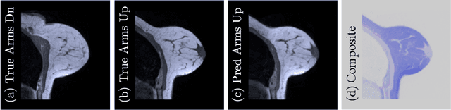 Figure 1 for Diffeomorphic Multi-Resolution Deep Learning Registration for Applications in Breast MRI