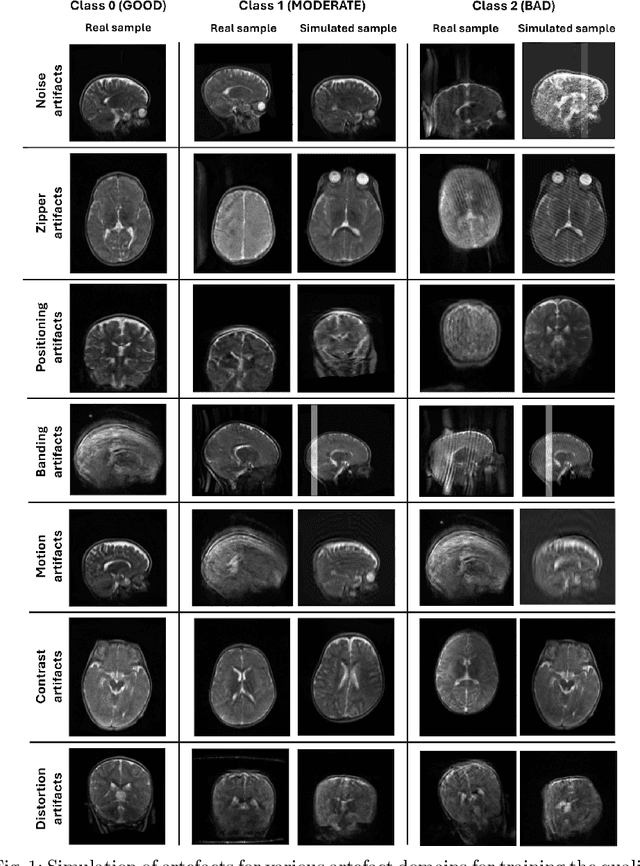 Figure 2 for Automated quality assessment using appearance-based simulations and hippocampus segmentation on low-field paediatric brain MR images