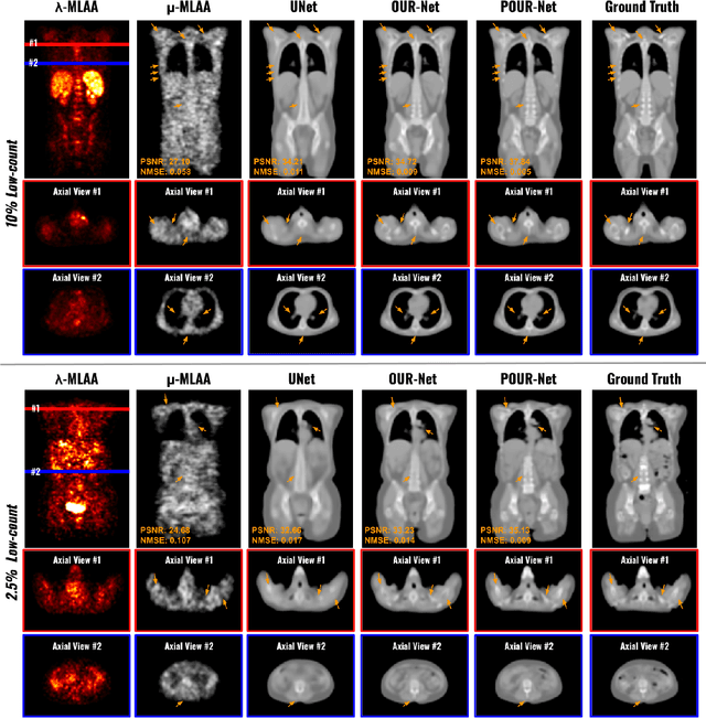 Figure 3 for POUR-Net: A Population-Prior-Aided Over-Under-Representation Network for Low-Count PET Attenuation Map Generation