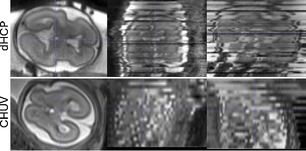 Figure 3 for Meta-learning Slice-to-Volume Reconstruction in Fetal Brain MRI using Implicit Neural Representations
