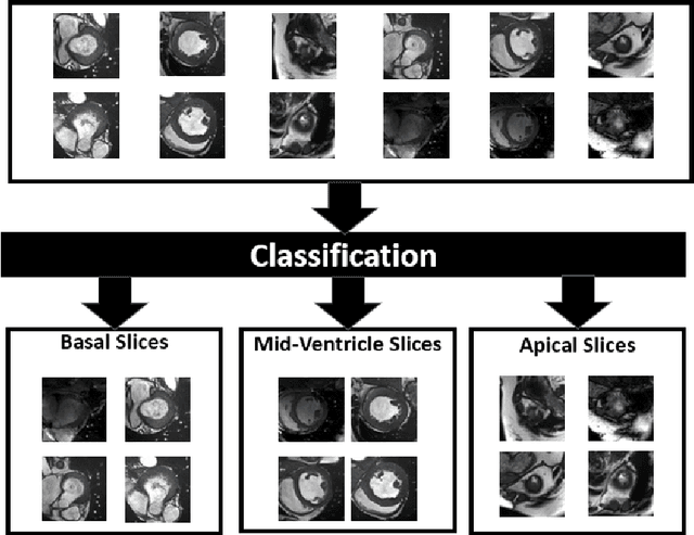 Figure 3 for Two-Phase Segmentation Approach for Accurate Left Ventricle Segmentation in Cardiac MRI using Machine Learning