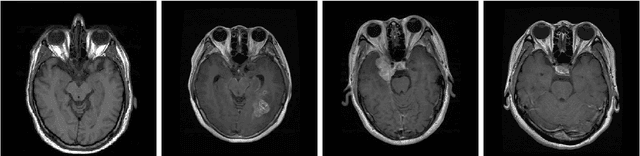 Figure 1 for Machine Learning Approach to Brain Tumor Detection and Classification