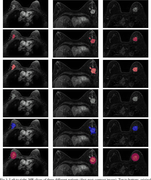 Figure 1 for Segmentation variability and radiomics stability for predicting Triple-Negative Breast Cancer subtype using Magnetic Resonance Imaging