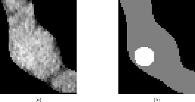 Figure 1 for Pancreatic Tumor Segmentation as Anomaly Detection in CT Images Using Denoising Diffusion Models